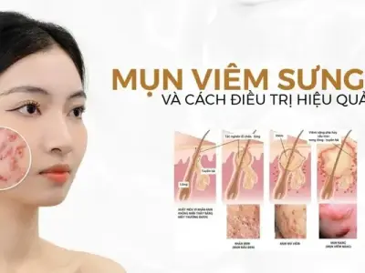 Cách trị mụn viêm tại nhà hiệu quả và ngăn tái phát đơn giản
