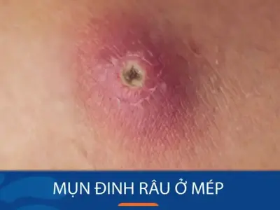 Cách trị mụn đinh râu hiệu quả an toàn tại nhà nhanh chóng