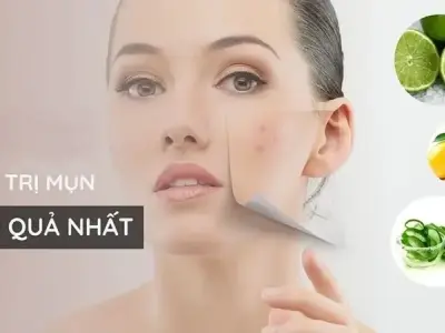 Cách trị mụn hiệu quả nhất giúp làn da khỏe đẹp tự nhiên