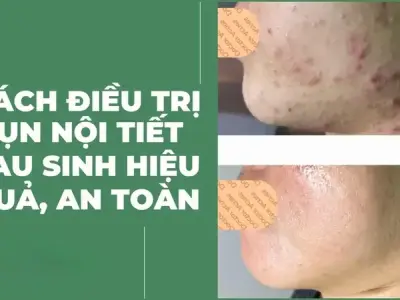 Cách trị mụn nội tiết sau sinh hiệu quả giúp da sáng khỏe