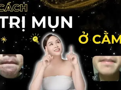 Cách trị mụn ở cằm hiệu quả tại nhà không để lại sẹo