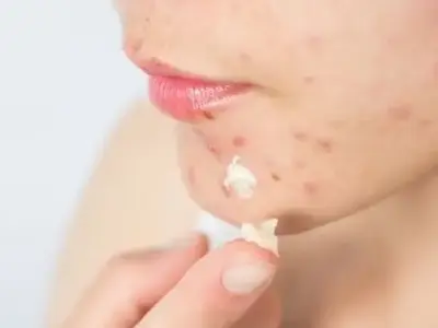 Cách trị mụn ở mép môi nhanh chóng lấy lại làn da xinh