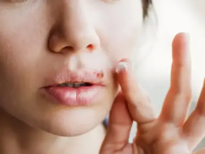 Cách trị mụn rộp nhanh chóng và ngăn ngừa tái phát hiệu quả