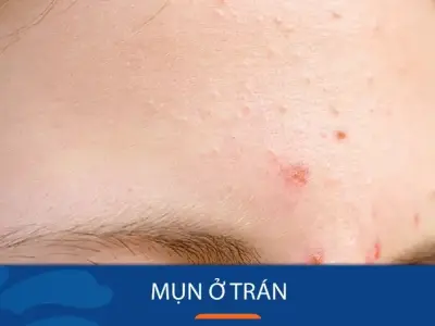 Cách trị mụn trên trán nhanh chóng hiệu quả cho mọi loại da