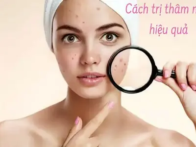 Cách trị thâm mụn hiệu quả và an toàn tại nhà cho mọi da