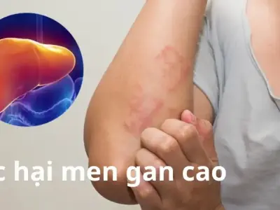 Tác hại men gan cao và những ảnh hưởng sức khỏe bạn cần biết