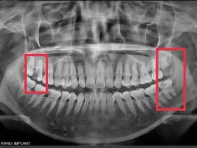 Tác hại răng khôn và những sự thật khiến bạn lo lắng