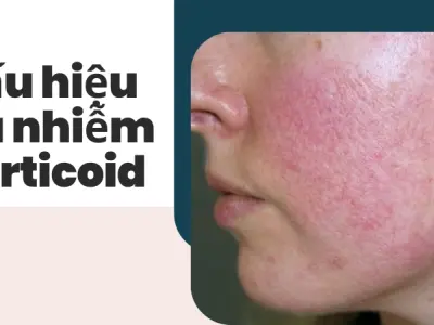Da nát vì kem trộn- Trải nghiệm kinh hoàng và cách cứu vãn