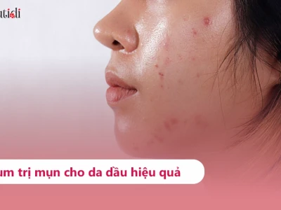 Bí quyết chọn serum trị mụn cho da dầu hiệu quả nhất 2026