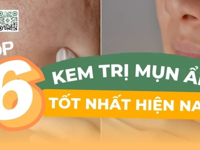 Bí quyết trị mụn ẩn cho da dầu hiệu quả ngay tại nhà