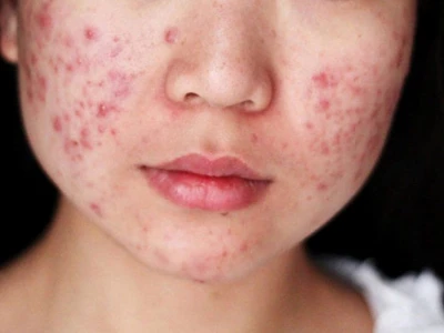 Miếng Dán Mụn Hàn Quốc: Giải Pháp Hiệu Quả Cho Làn Da Sạch Mụn