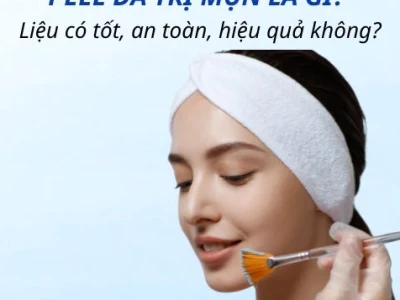 Peel da có đẩy mụn không và cách xử lý hiệu quả